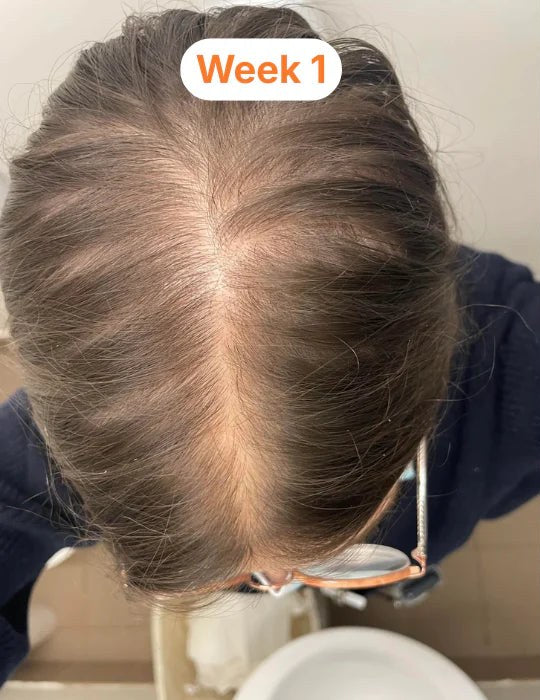 Wide part line at week 1, scalp clearly visible