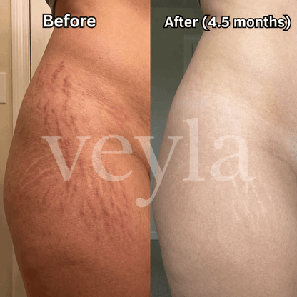 Veyla™ Clinical Acne Scar Repair Stick