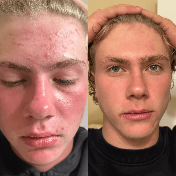 Veyla™ Clinical Acne Scar Repair Stick