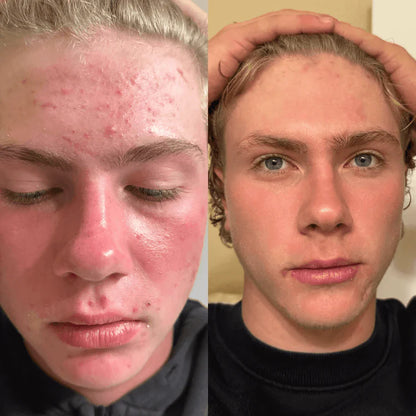 Veyla™ Clinical Acne Scar Repair Stick