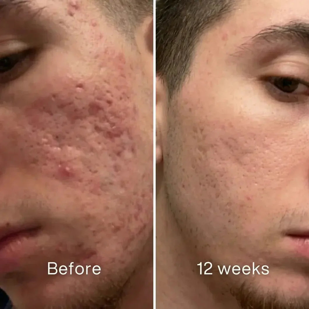 Veyla™ Clinical Acne Scar Repair Stick