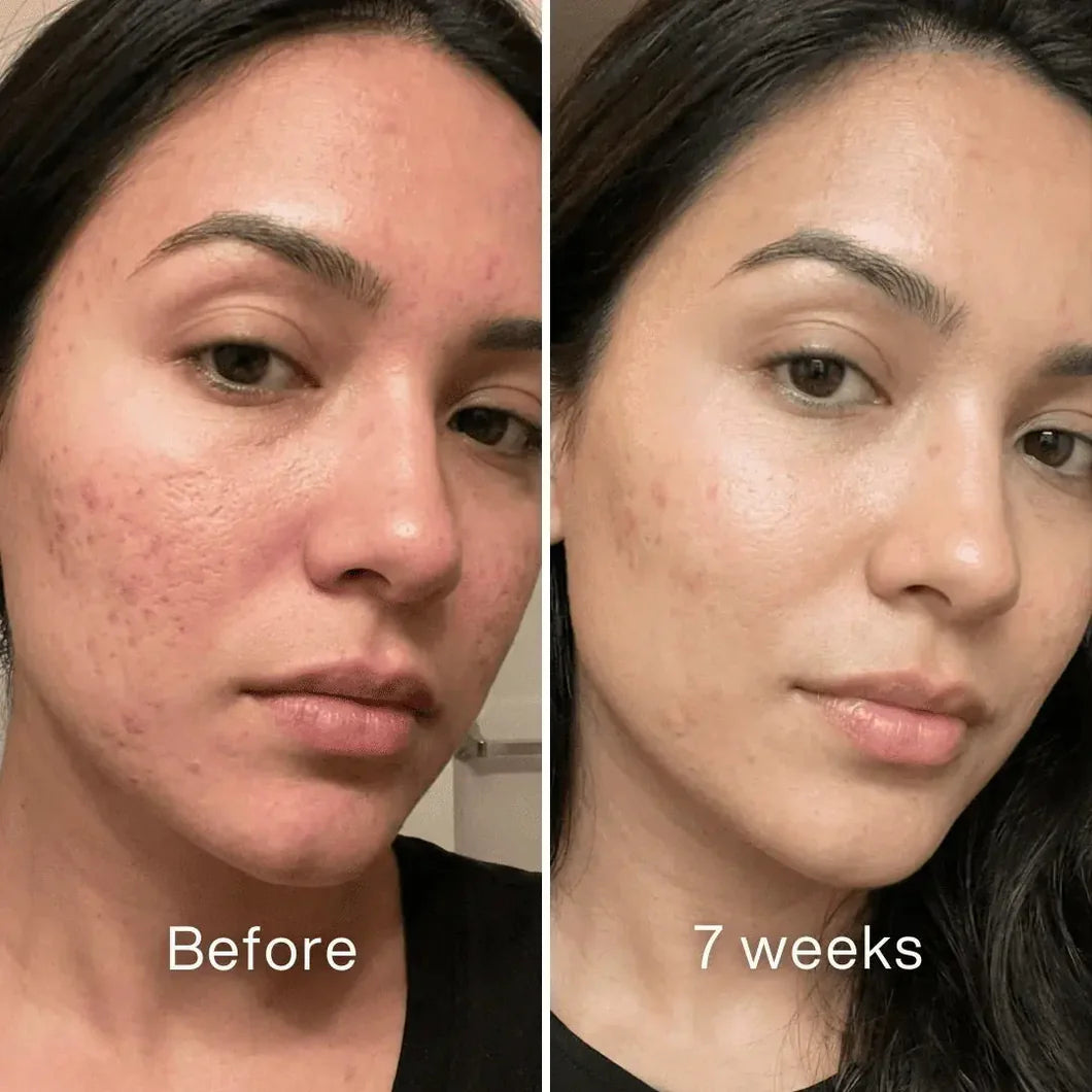 Veyla™ Clinical Acne Scar Repair Stick