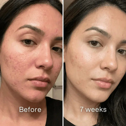 Veyla™ Clinical Acne Scar Repair Stick
