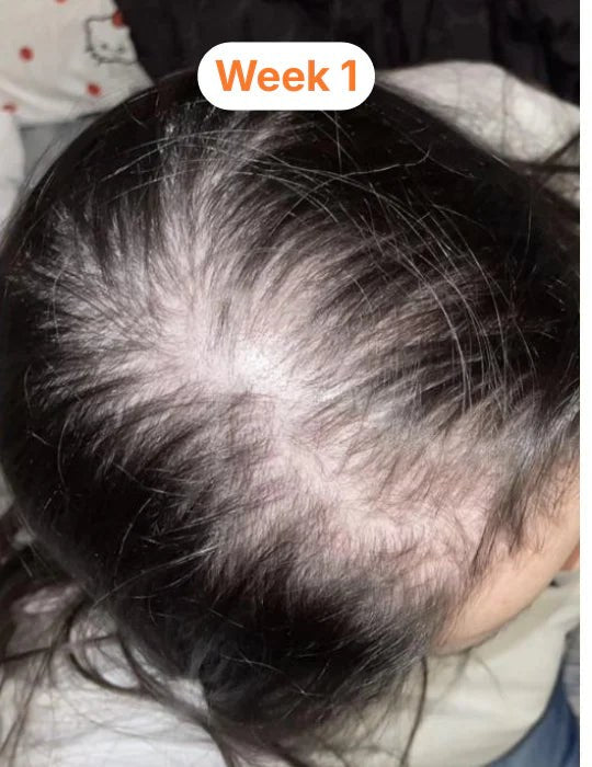 Diffuse thinning across the crown at week 1