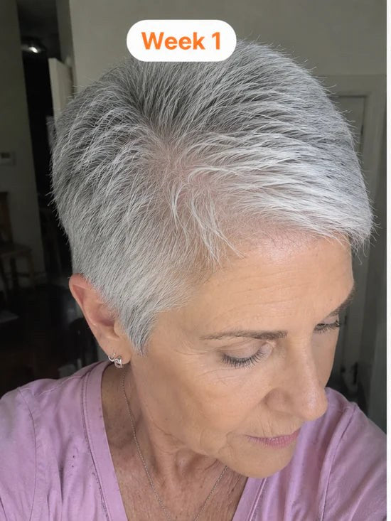 Thinning through grey hair at the temple, week 1