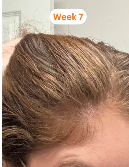 The same hairline at week 7 with new baby hairs