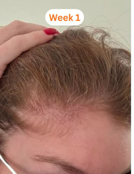 Receded hairline at the temple, week 1